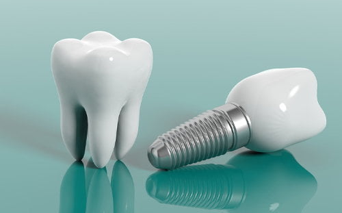 service-img3 dental implant services in kolkata
