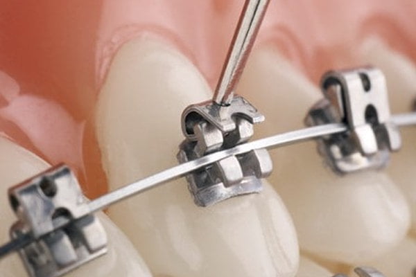 Self Ligation Metal Brace Self Ligation Metal Brace