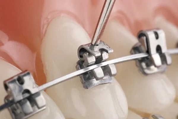Self Ligation Metal Brace Self Ligation Metal Brace
