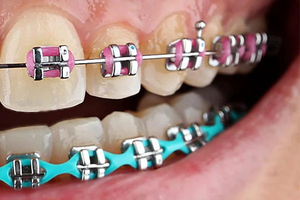 Metal Brace Metal Brace