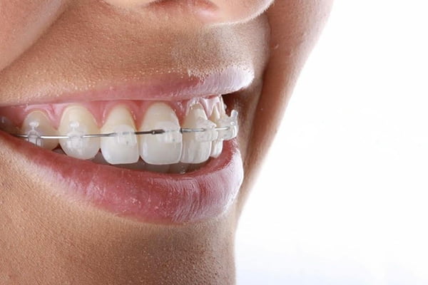 Self Ligation Ceramic Brace Self Ligation Ceramic Brace