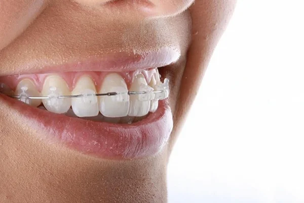 Self Ligation Ceramic Brace Self Ligation Ceramic Brace