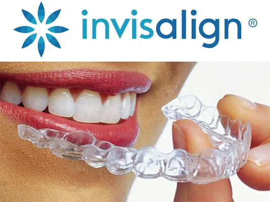 type 1 invisalign alingers in south kolkata