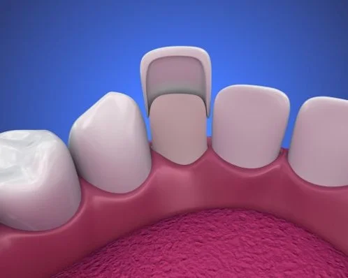 Picture1 Dental Veneers