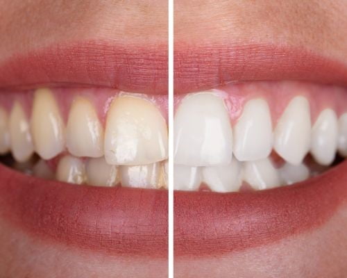 teeth Whitening