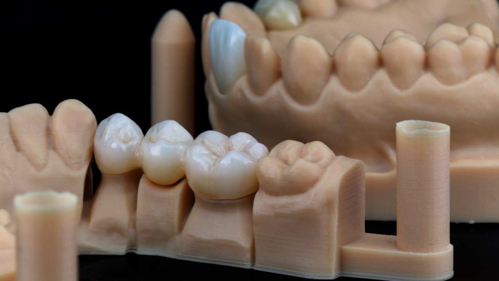 what are dental crown?