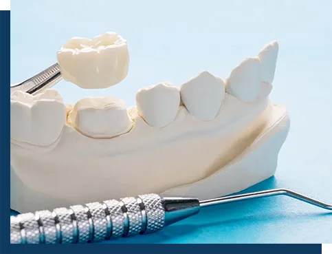 Ceramic Crowns Ceramic Crowns
