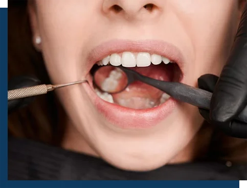 Gum Depigmentation Gum Depigmentation