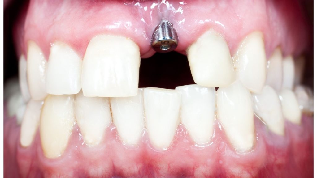 Missing tooth Missing tooth