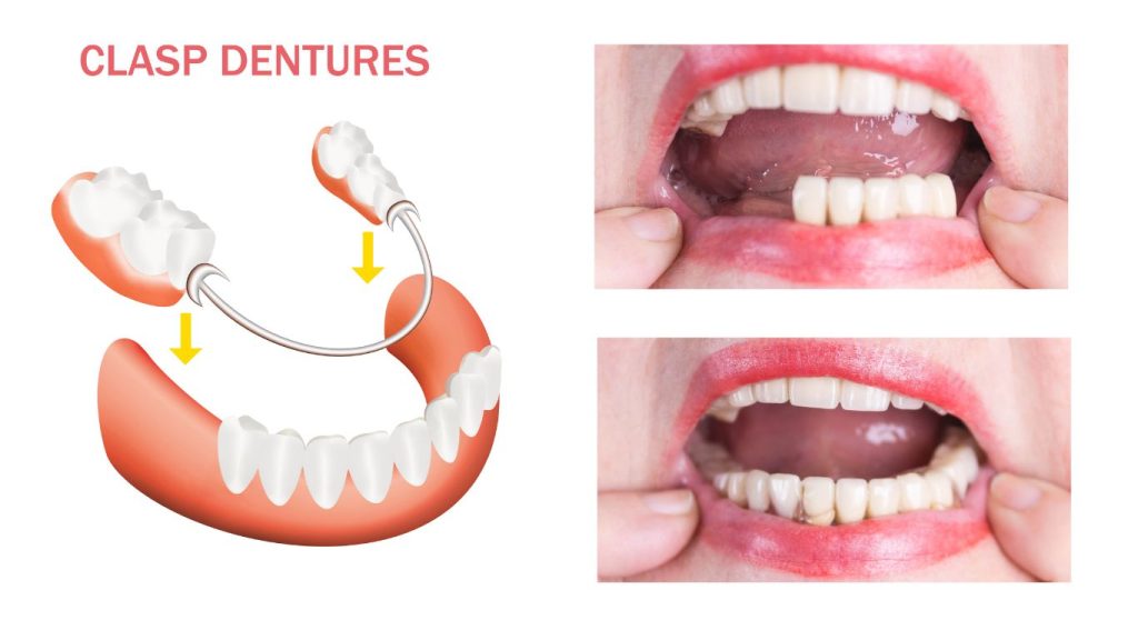 Full Mouth Rehabilitation photo Full Mouth Rehabilitation photo