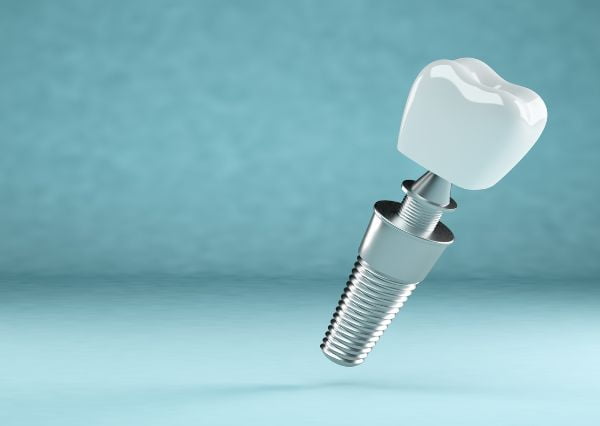 dental implants in kolkata