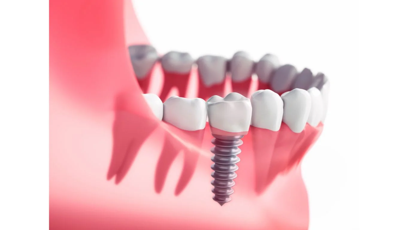 what are dental implants what are dental implants