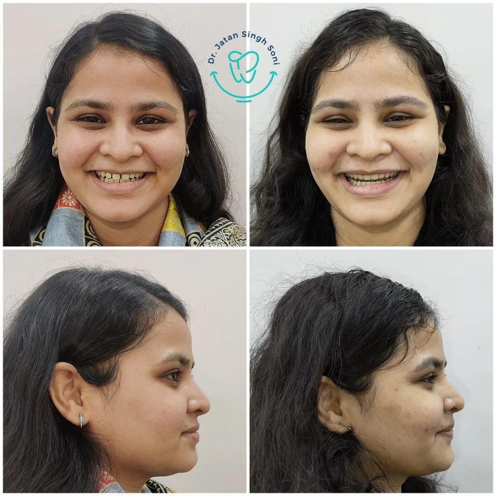 smile makeover treatment before and after photo smile makeover treatment before and after photo