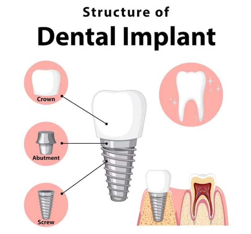 structure of a dental implant structure of a dental implant