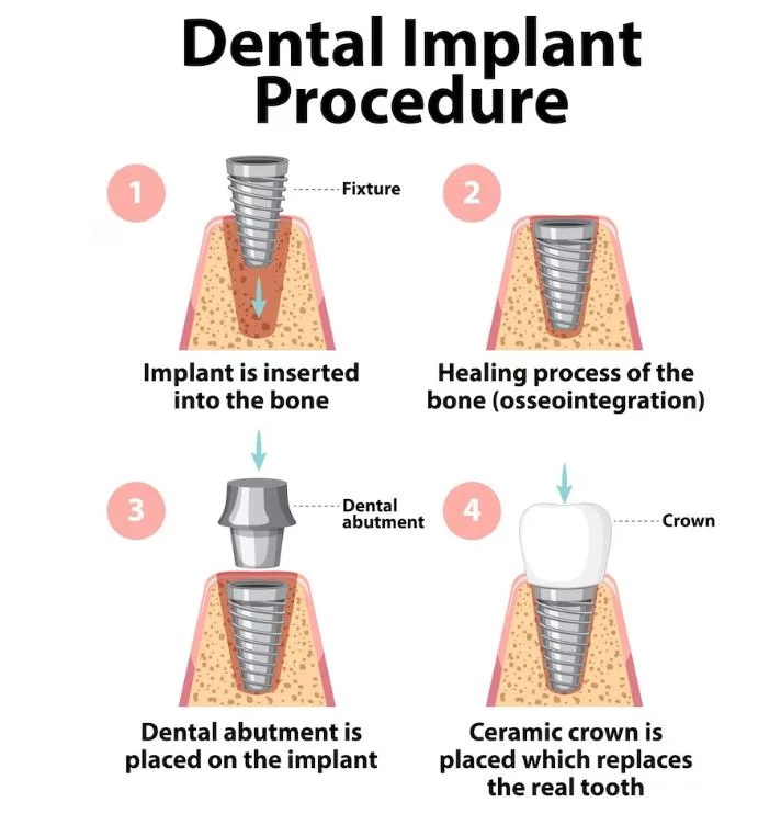 dental implant procedure dentla implant procedure