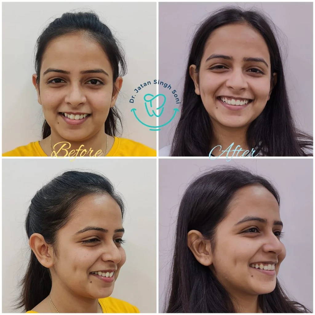Teeth Whitening treatment before and after photo Teeth Whitening treatment before and after photo