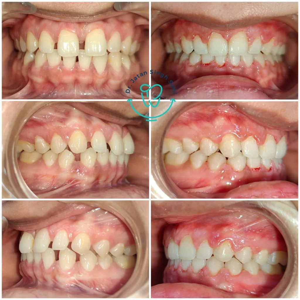 Teeth Recontouring before and after photo Teeth Recontouring before and after photo