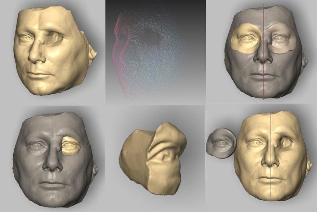 facial-prosthesis facial-prosthesis