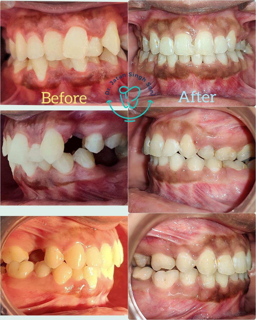 Polish_20230401_204641493-min-min Tooth Fillings and Restorations