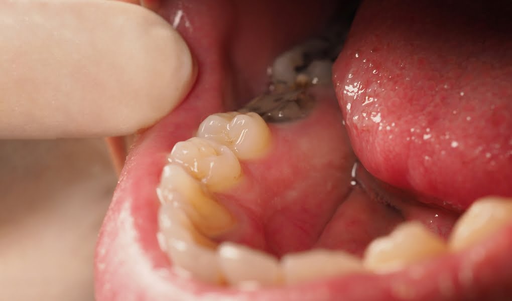 Untitled design (27) root canal treatment