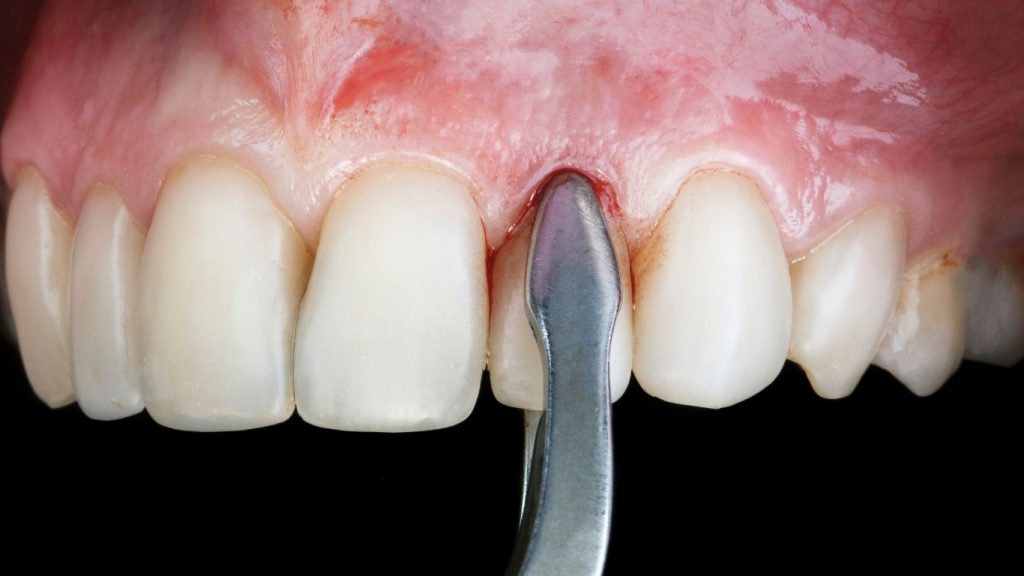 tooth extraction tooth extraction