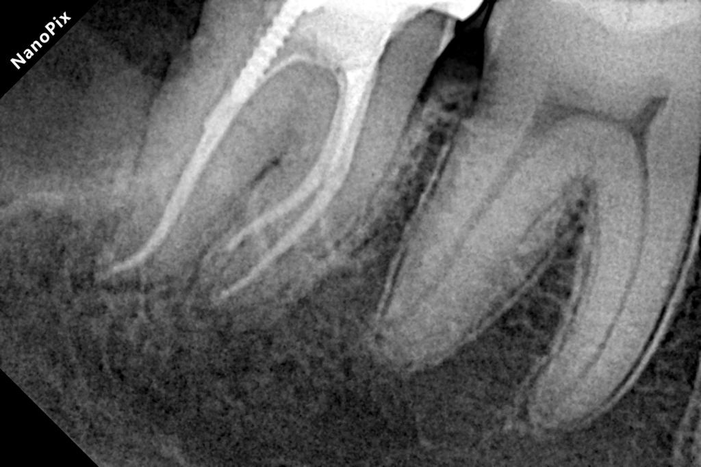 3 AFTER-min root canal treatment after picture