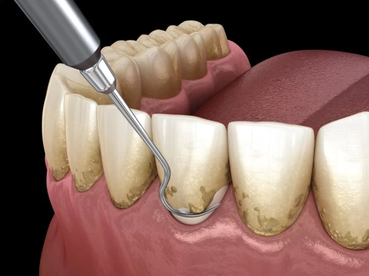 sasss Teeth Scaling